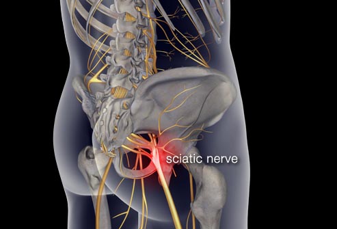 Sciatica Treatment