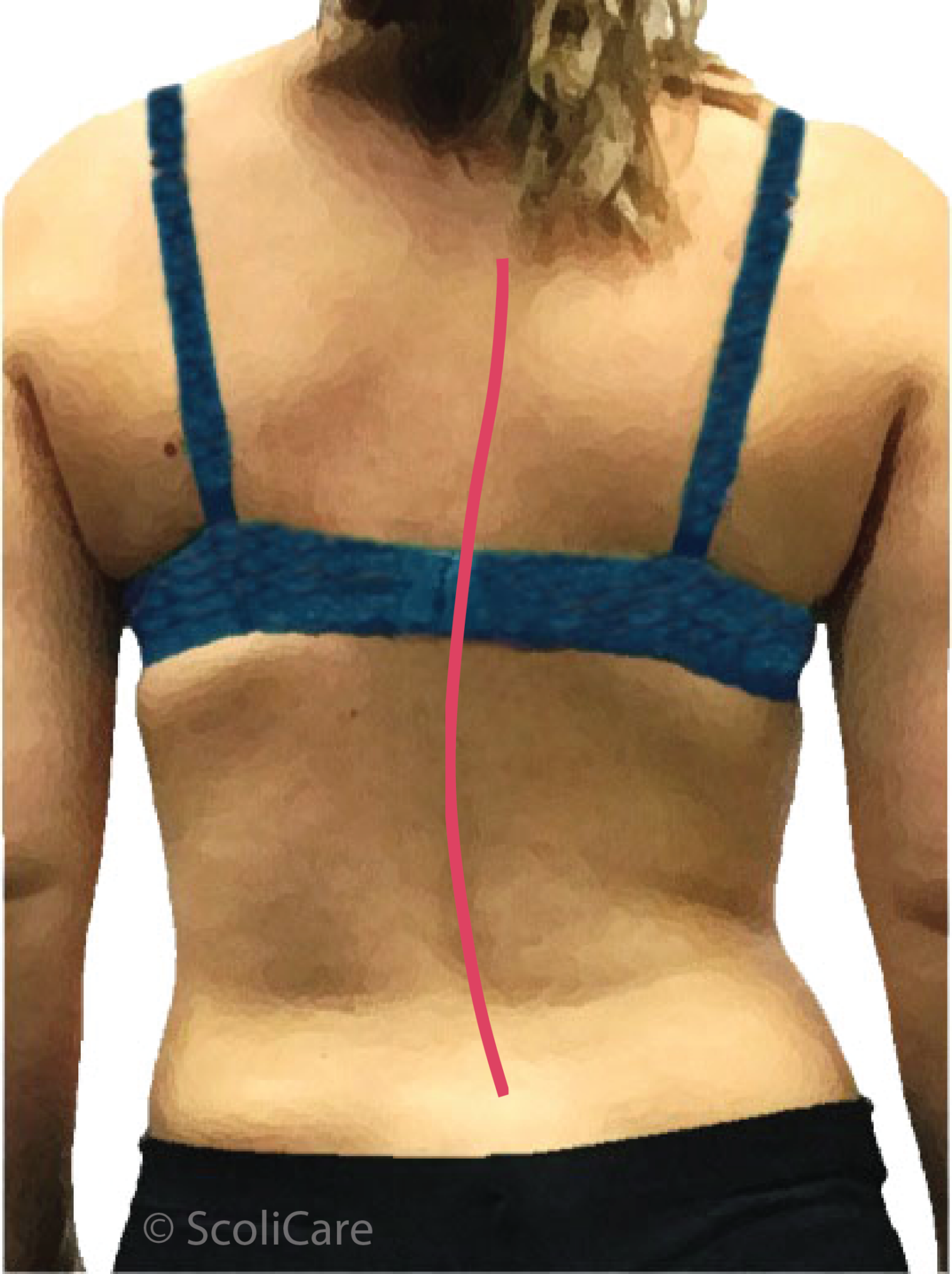 a young woman with visible scoliosis curve development