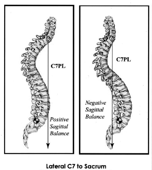 A Strong Spine for Long-Term Quality of Life