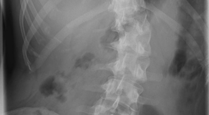 x-ray of an adult with scoliosis