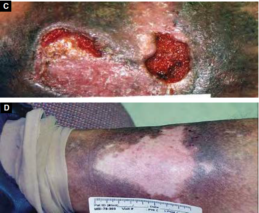 venous ulcer before and after laser therapy treatment