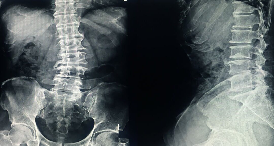 Can Scoliosis Be Fixed Without Surgery?