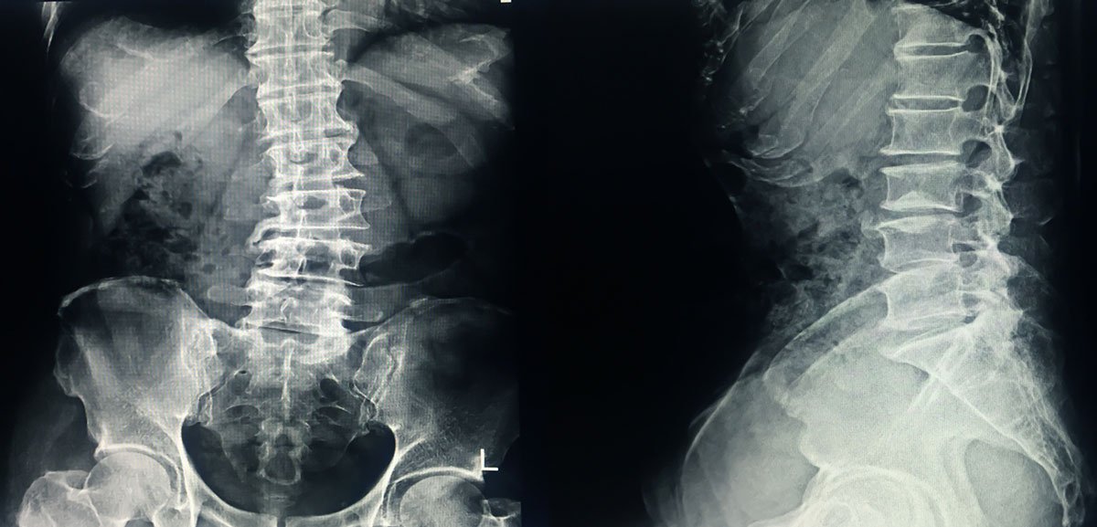 Scoliosis X-Ray, back and side view