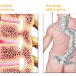 illustration of intervertebral disc herniation and scoliosis of the spine