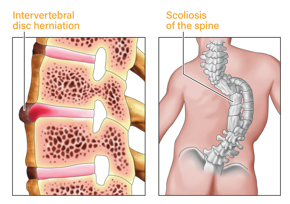 illustration of intervertebral disc herniation and scoliosis of the spine