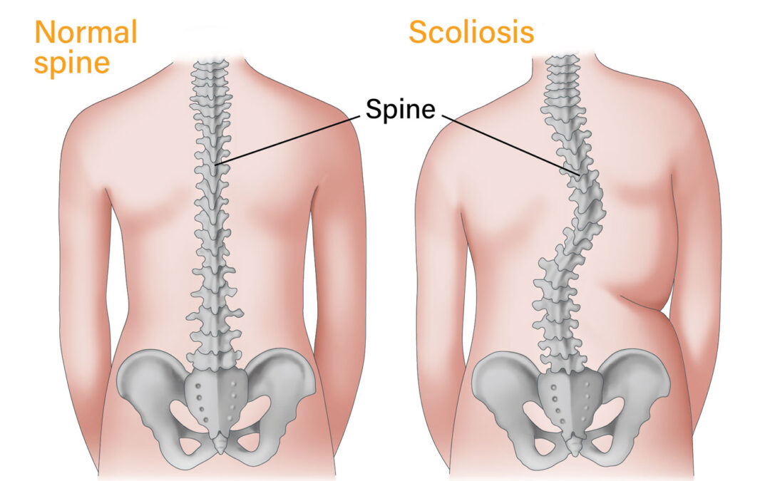 Can Scoliosis Cause Herniated Discs?