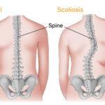 illustration of a spine with scoliosis versus a normal spine