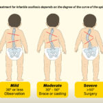 diagram demonstrating mild, moderate, and severe scoliosis in infants