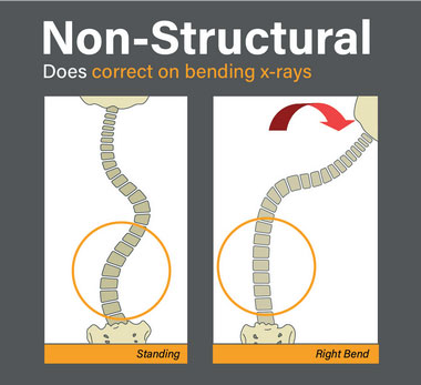 an illustration of non-structural scoliosis