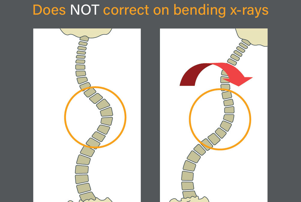 The Differences Between Non-Structural And Structural Scoliosis