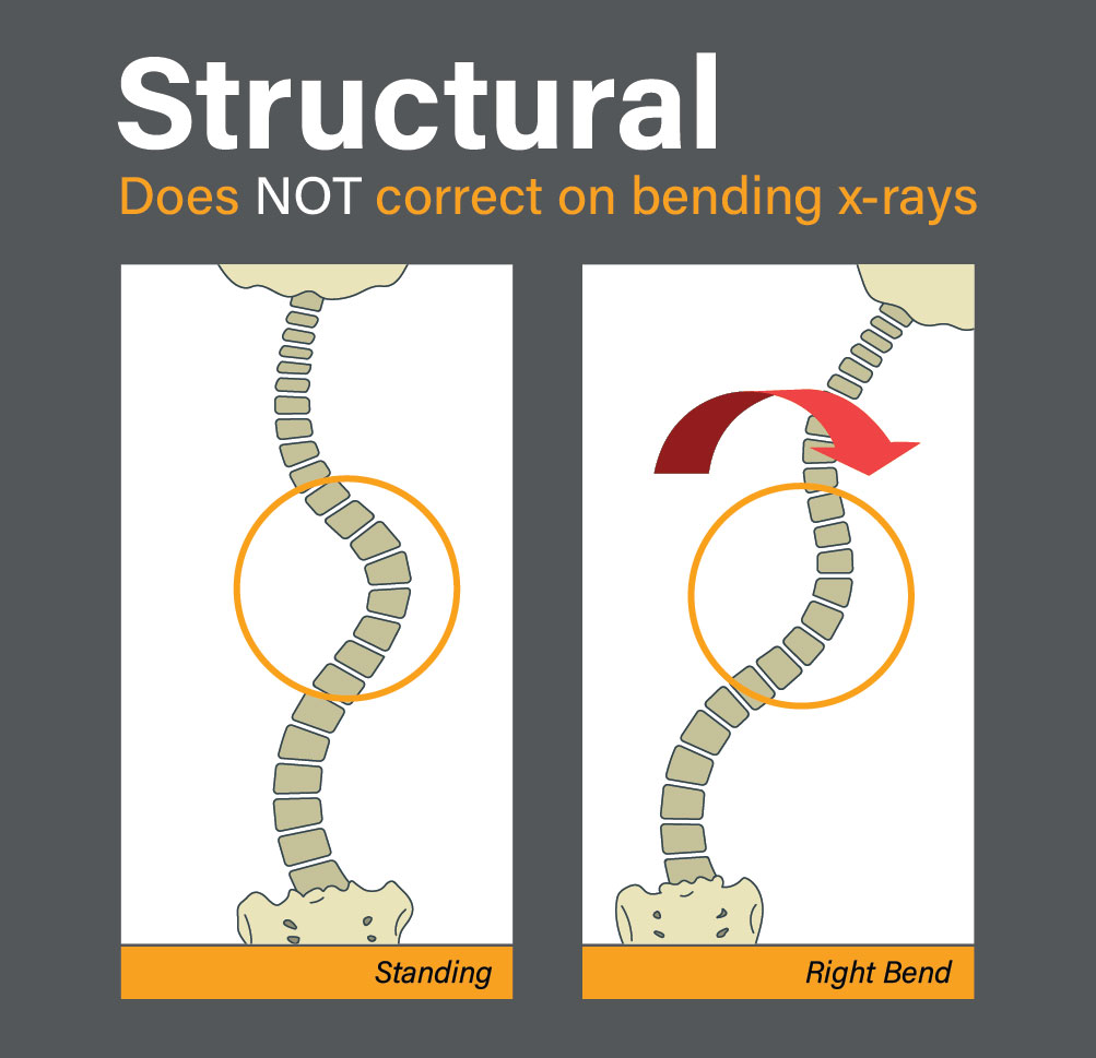 an illustration of structural scoliosis