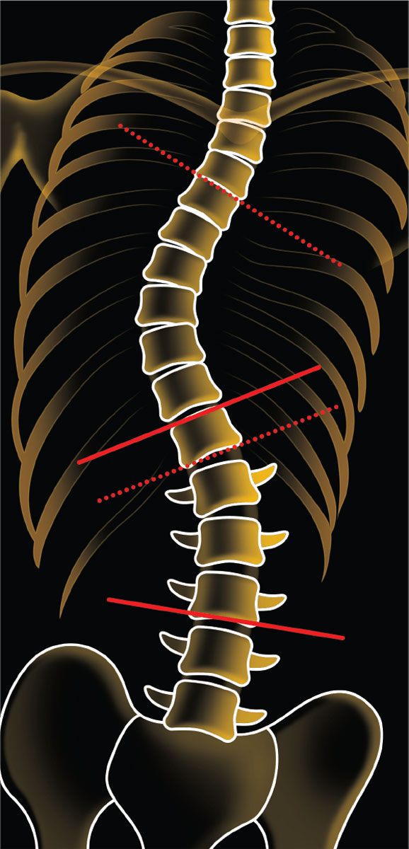 Adult Scoliosis Treatment: Know Your Options – Square ONE