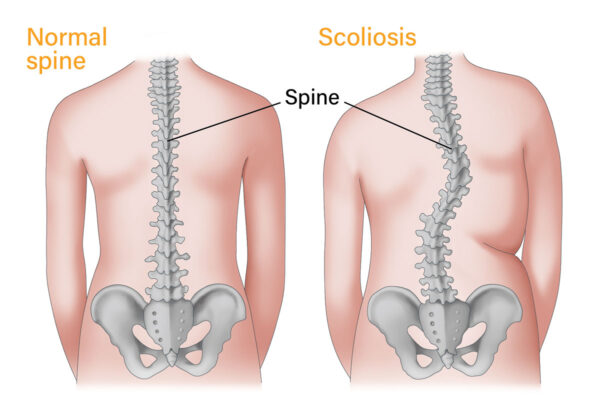 normal spine vs scoliosis