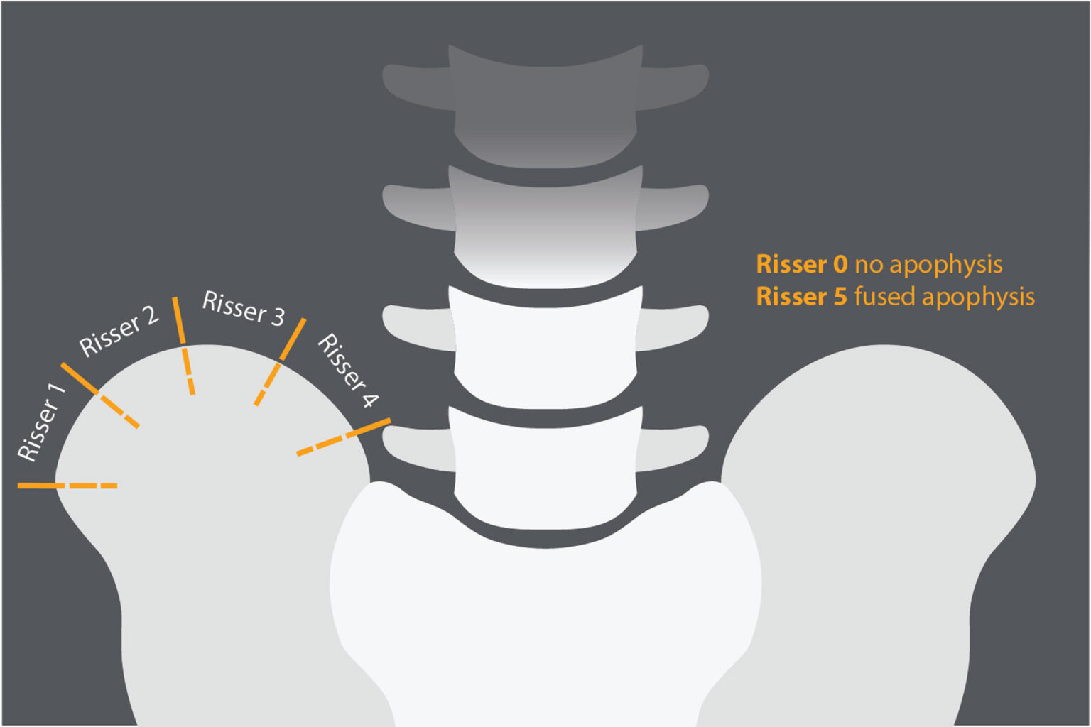 Risser Sign In The General Diagnosis Of Scoliosis - Square ONE