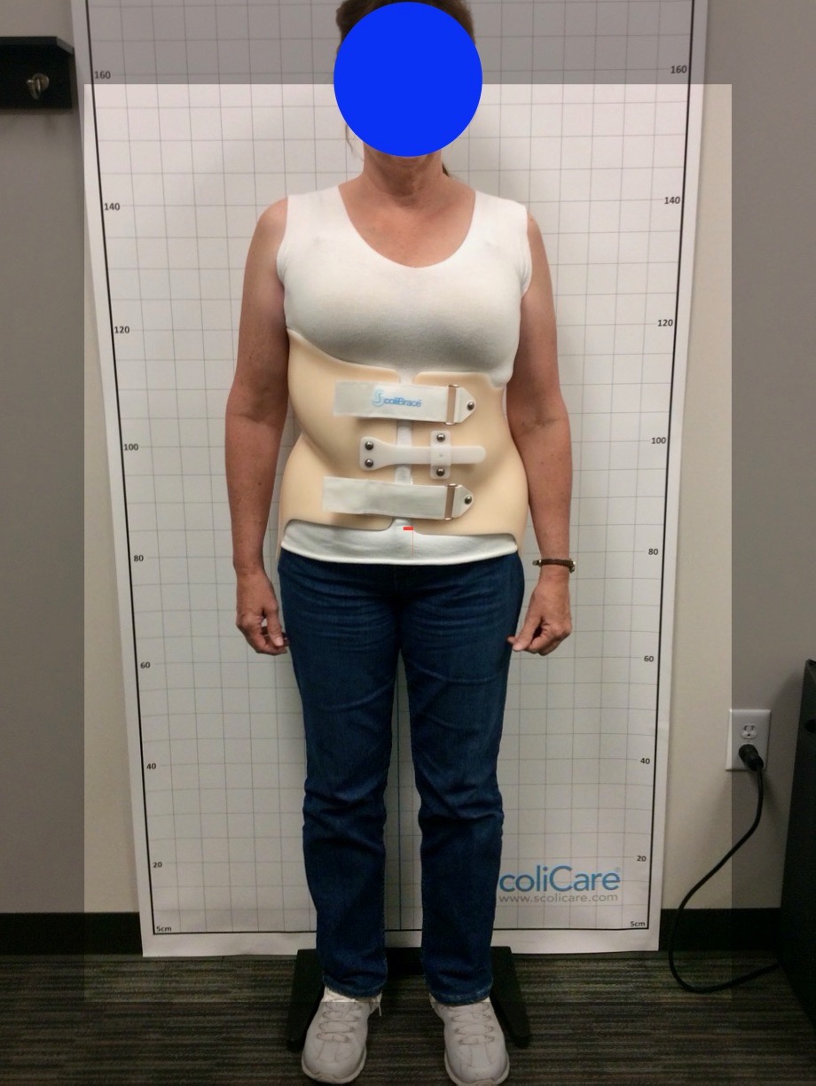 Scoliosis Fort Collins